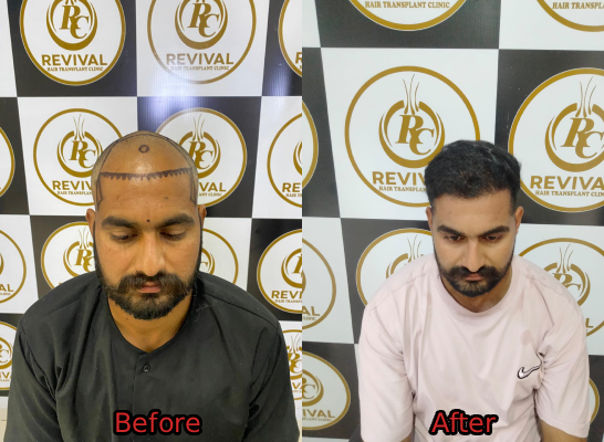 Hair Transplant Result 4